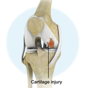 Knee Injury