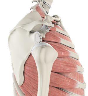 Shoulder Labrum Reconstruction