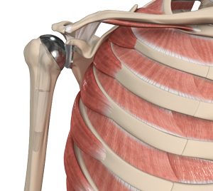 Shoulder Joint Replacement